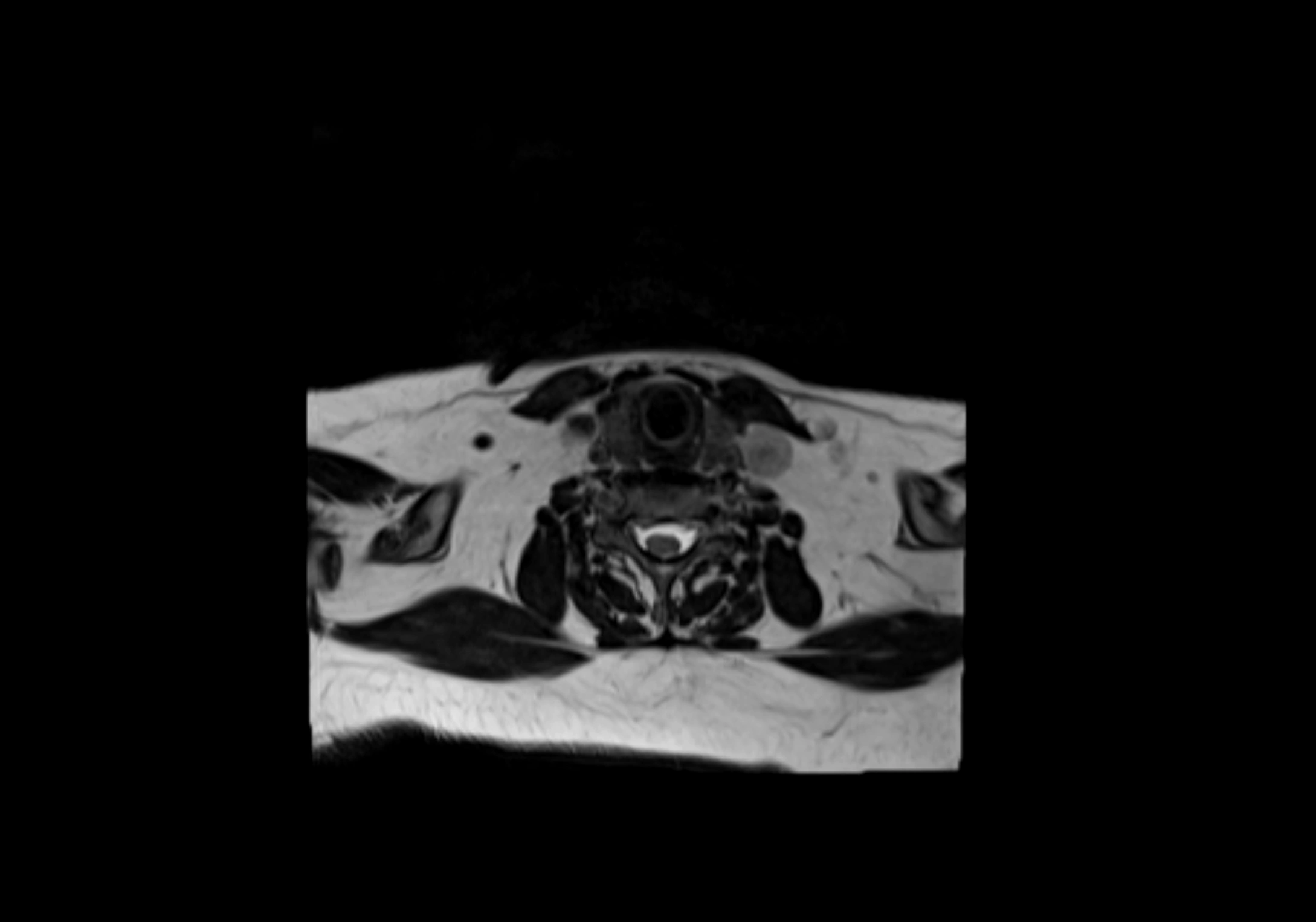 Neck axial  lymph node cross sectional MRI anatomy 3T MRI  image-img-00001-00074.webp
